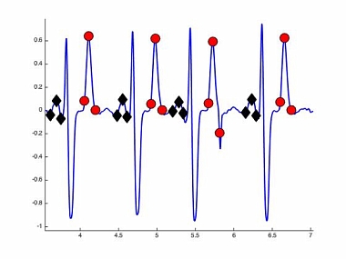 Détection et estimation des ondes P et T dans les signaux ECG