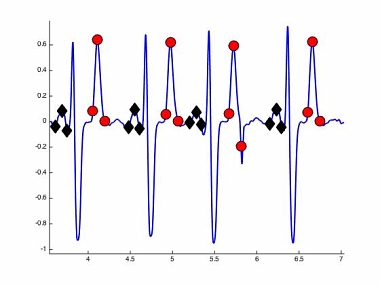 P and T wave detection and estimation in ECG signals